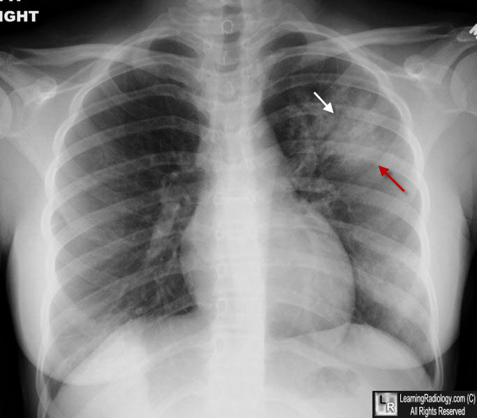 left upper lobe pneumonia, air bronchogram